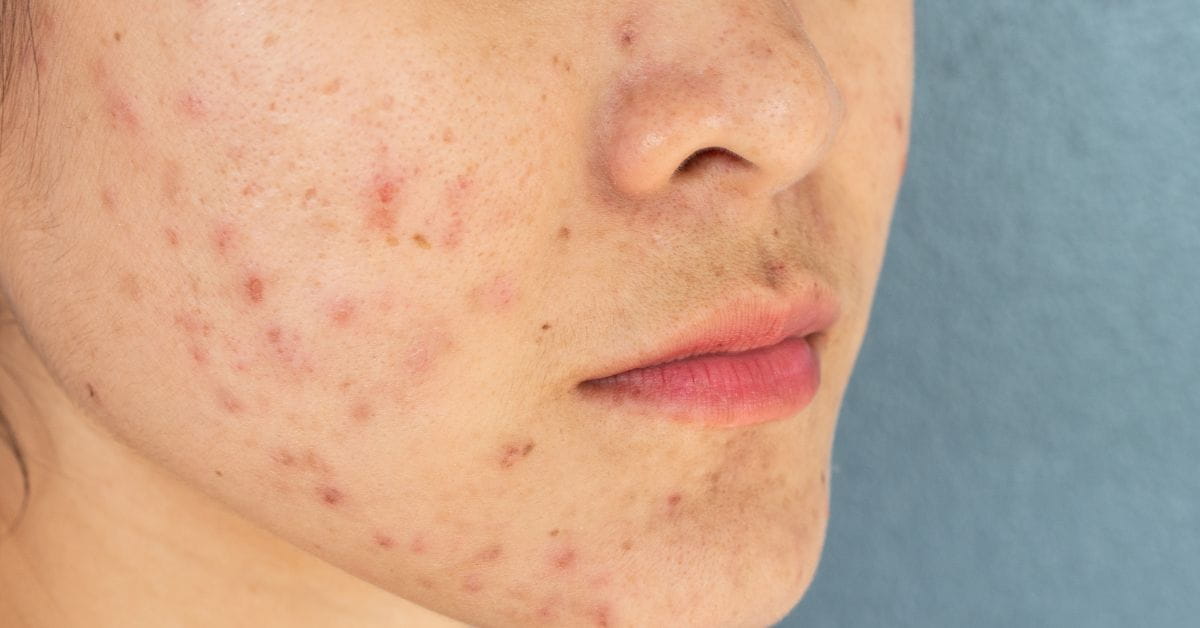 Acne - DR. SHEFALI BANSAL MADHAV Blog